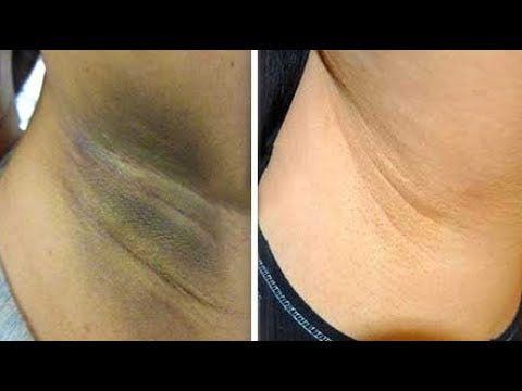 Como Clarear as Axilas: Guia Completo, Seguro e Eficiente (Passo a Passo)