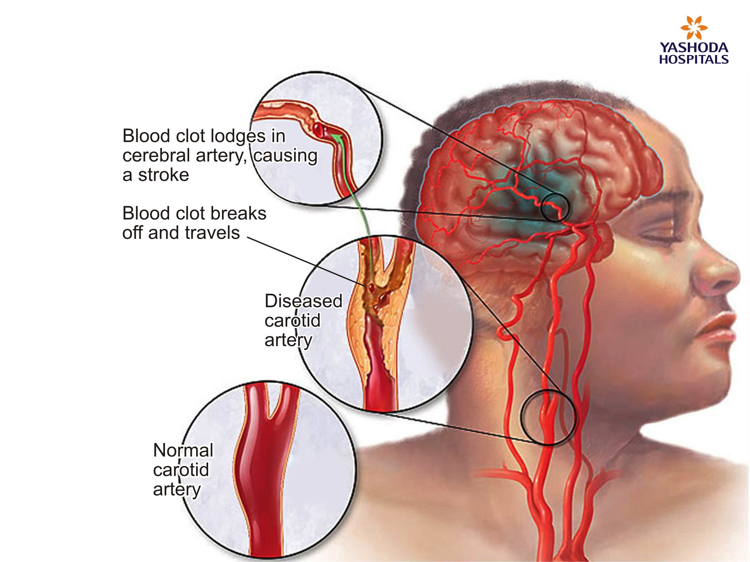 Stroke org. Микроангиопатия сосудов головного мозга. Гемодигамическиы инсульт. Гемодинамический ишемический инсульт. Церебральная сосудистая микроангиопатия.