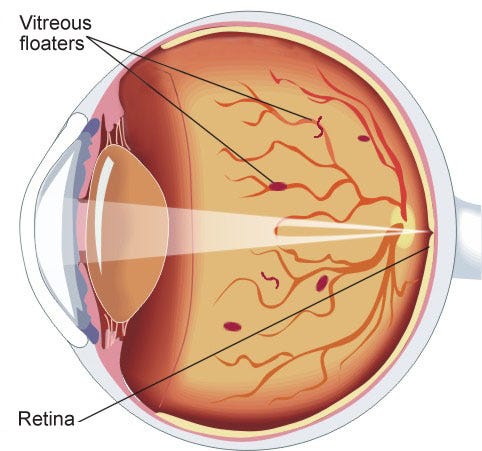 Строение глаза человека без подписей. Ламеллярный разрыв макулы. Деструкция стекловидного тела. Капсульный мешок строение глаза. Воспаление стекловидного тела глаза на латинском.