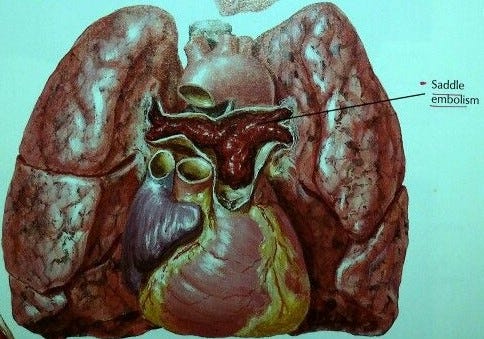 Saddle Pulmonary Embolism. Saddle pulmonary embolism is a type of… | by Dr  Pranav Shinde | Medium
