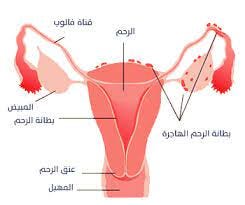 بطانة الرحم المهاجرة وطرق العلاج. تعتبر عملية بطانة الرحم المهاجرة من… | by  medicalinfo | Medium