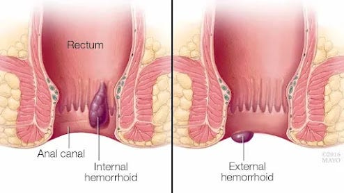 HEMORRHOIDS EXPLAINED