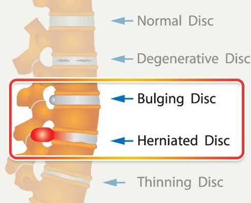 The nature of herniated discs and what causes them | by JongHwa Lee ...