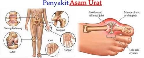 5 Obat Asam Urat Terbukti Ampuh Paling Mujarab
