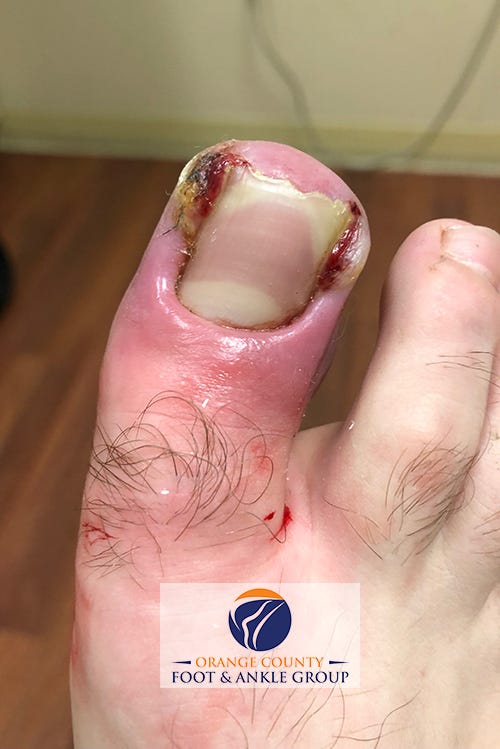 Ingrown toenail non-invasive treatment - The Foot Group