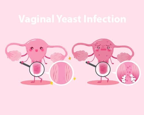 💖 Vaginal Discharge: Causes, Types, Symptoms and Treatment