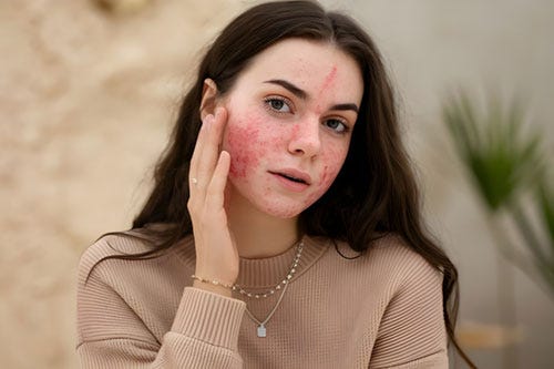 Topical Steroid Damaged Facies (TSDF) | Why Do People Misuse Topical Steroids | Side-Effects…