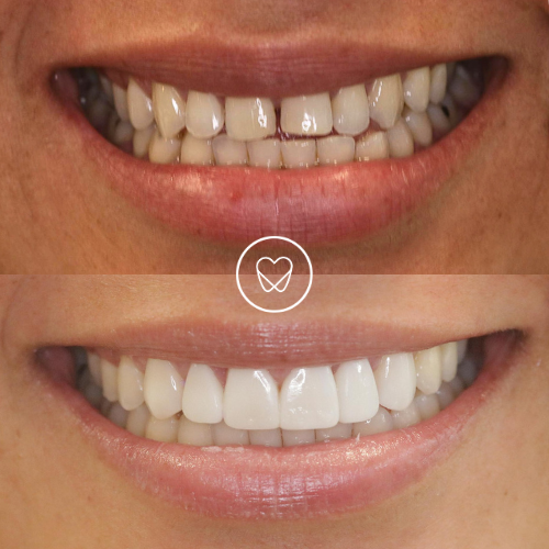 The Rise of Composite Bonding: Enhancing Smiles in Sydney by Delight