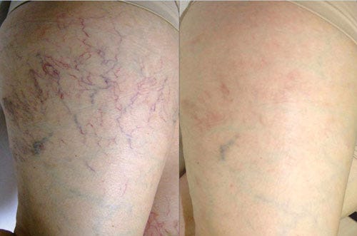 Spider Vein Removal Laser Treatment | by Aesthaticclinic | Jun, 2023 |  Medium