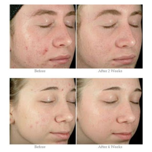 What Are the Type Of Acne Scars And How Dermatologist Acne Scars Can