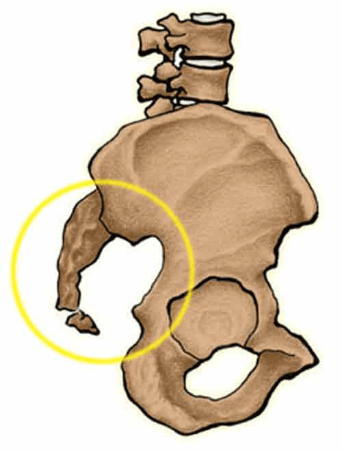 Avoid Surgery to Remove the Tailbone (Coccygectomy)