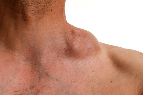 Lymphoma: Causes, treatment and risk factors