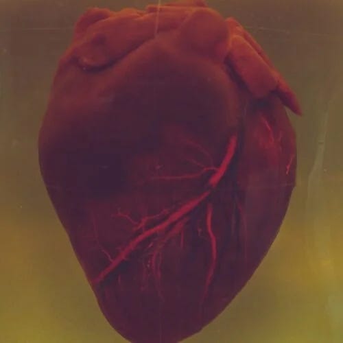 Cardiovascular Events in Lupus