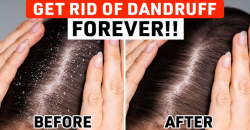 How To Get Rid Of Dandruff With Dreads medium.com