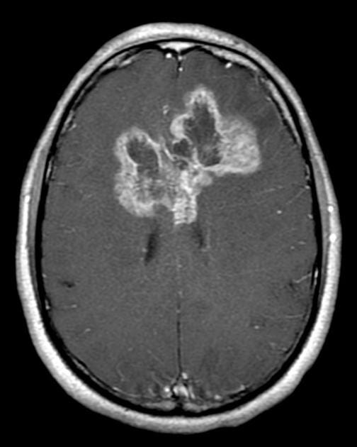 Glioblastoma Multiforme Characteristics, Risk Factors, and Treatment