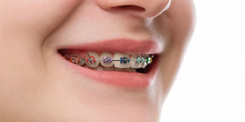 What are The Facts to Know About Clear Braces?, by goldenbergorthodontics, Mar, 2024