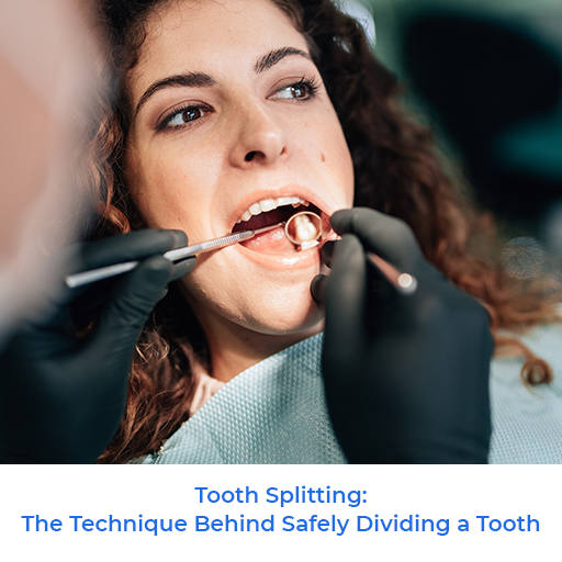 Tooth Splitting The Technique Behind Safely Dividing a Tooth by Premier Periodontics and