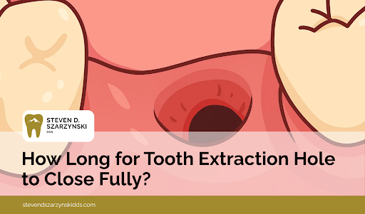 How Long for Tooth Extraction Hole to Close Fully?