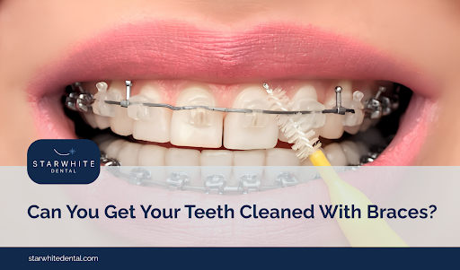Can You Get Your Teeth Cleaned With Braces?