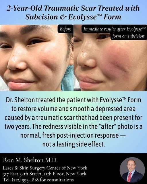 Immediate Results: Subcision + Evolysse™ Form for a 2-Year-Old Scar