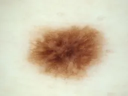 How to Build a U-Net for Melanoma Detection Using TensorFlow/Keras 4 melanoma-detection