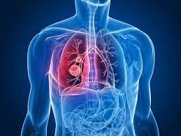 Cellular breakdown in the lungs: Unwinding the Signs and Symptoms** | by  Navaidshoukat | Medium