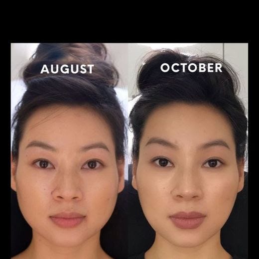 Masseter Botox Before And After A Comprehensive Guide By Heerjawad masseter-botox-before-and-after-a-comprehensive-guide-by-heerjawad