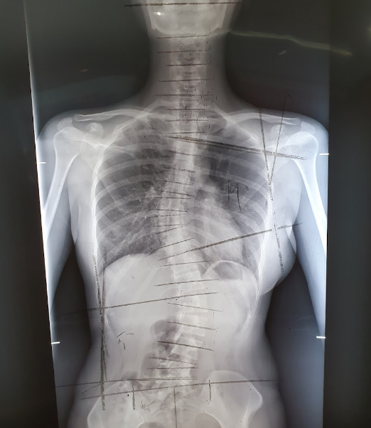 What is Xray Analysis and Interpretation — Get a Short Note by Atlas