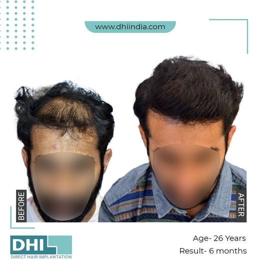 Hair Transplant in Chennai — DHI India by DHI India Medium