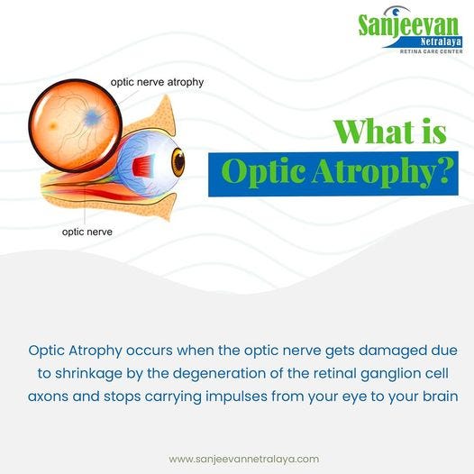 What Is Optic Atrophy. Optic Atrophy occurs when the optic… | by ...