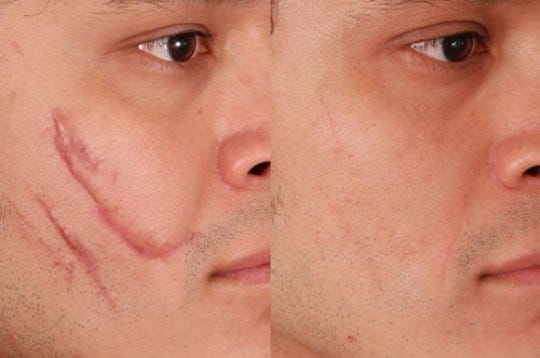 What Are the Risks of Laser Scar Removal? | by Aesthaticclinic | Medium