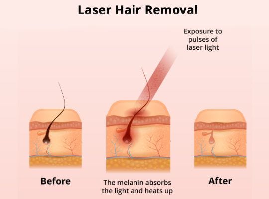 Laser Hair Removal