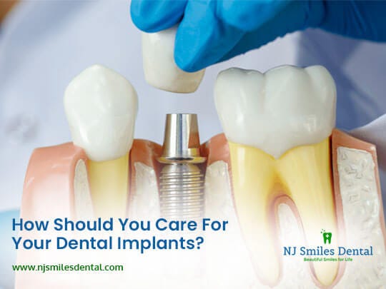 How Should You Care For Your Dental Implants? | by NJ Smiles Dental of ...