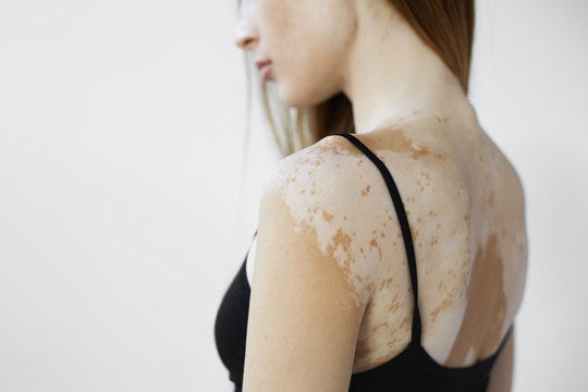 Managing Your Emotional Health With Vitiligo