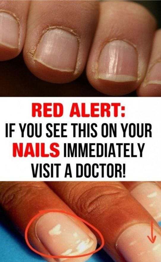 Red Alert: If You See This On Your Nails Immediately Visit A Doctor ...