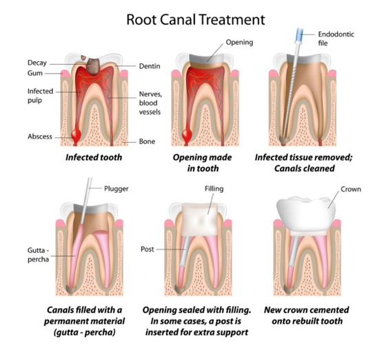 Best and Affordable Root Canal treatment in Pune by Shivraj Patil
