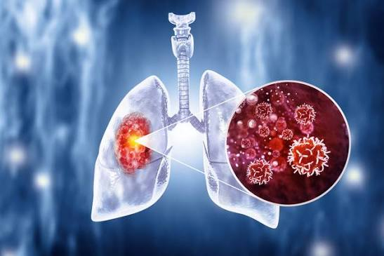 Lung Cancer: 9 Ways of Cancer Symptoms, Causes, Diagnosis, Treatment, Prevention, and the Latest…