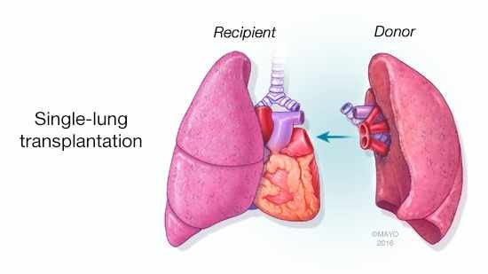 Scenario of Lung Transplantation in India | by Medmonks | Medium