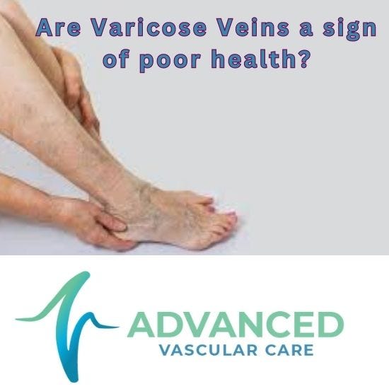Are Varicose Veins A Sign Of Poor Health? Dr David Harries Medium