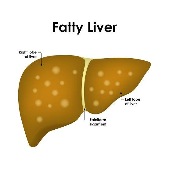 What Are the Symptoms of Fatty Liver Disease? Causes, Warning Signs, Diagnosis, and Treatment