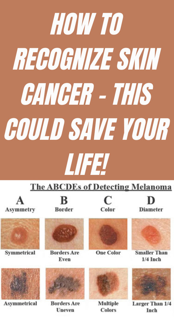 How To Recognize Skin Cancer — This Could Save Your Life! - Paula - Medium