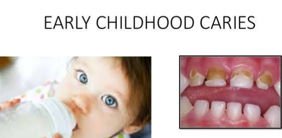 Know About Early Childhood Caries Nursing Caries Its Prevention By   1*NwDVzFbtsuRTkqsTwnQ Uw 