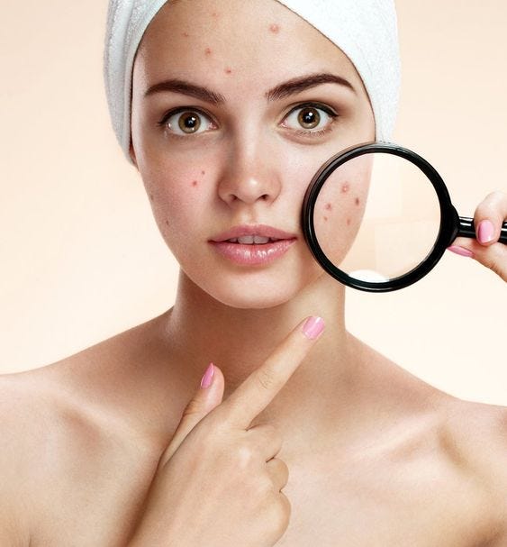 Acne Removal in San Ramon