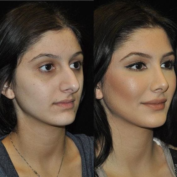 Best Nose Plastic Surgery Hyderabad by Saikiran Medium