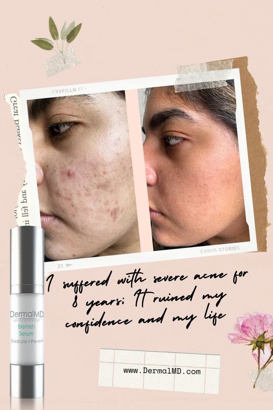 DermalMD Acne Serum #1 Best Acne Serum | by Tammy Jamiere | Medium