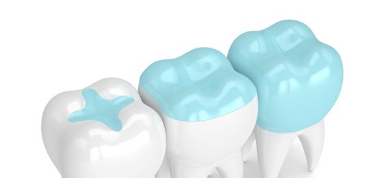 Revitalize Your Smile: Exploring the Porcelain Inlays and Onlays