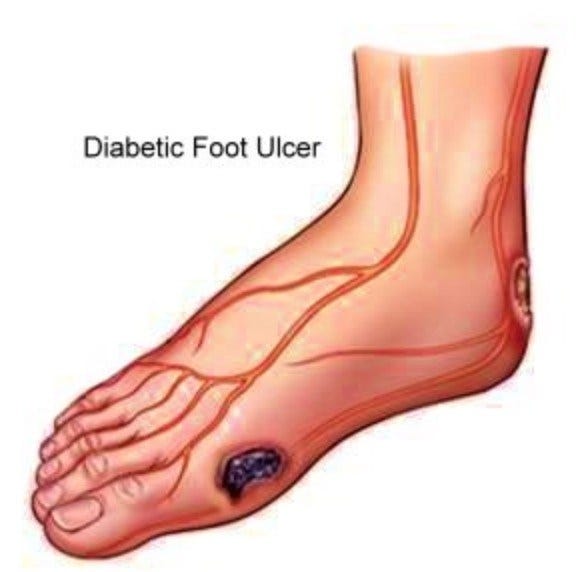 венозная трофическая язва. гематома голеностопного сустава. пиогенные трофические язвы. варикозное расширениемвен. пиогенные трофические язвы.