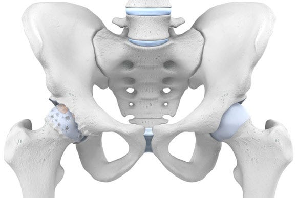 Hip Pain Treatment in Delhi | Dr. Amod Manocha