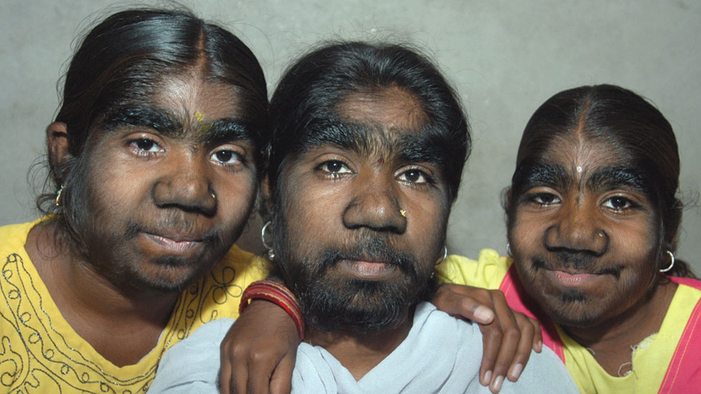 ланугинозный гипертрихоз. косметика до и после. макияж трансформация. негритянка с кукольной внешностью. самые необычные модели.