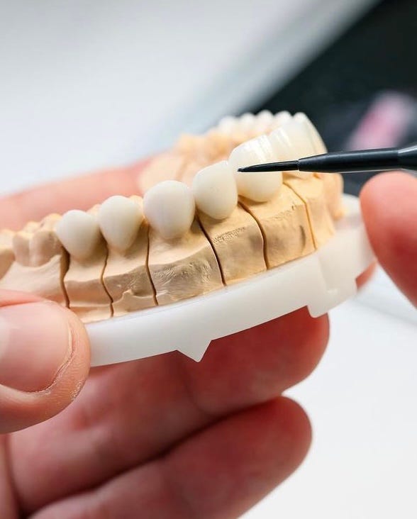 Decoding Veneer Costs Understanding Influential Factors, Average Costs